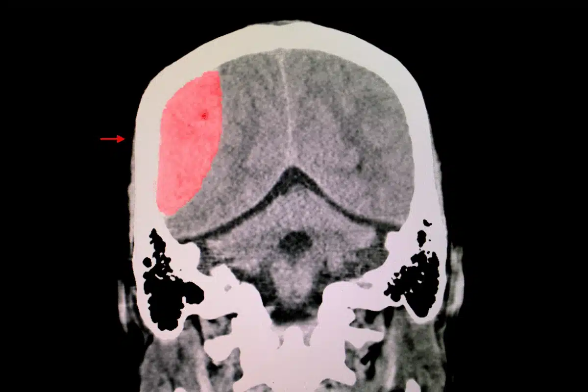 Florida Traumatic Brain Injury Lawyer - FHVG